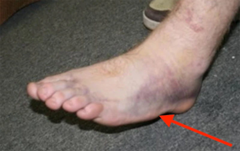 Base of 5th Metatarsal Fracture Treatment Melbourne | Big Toe Fusion