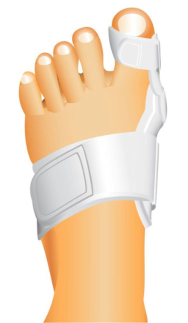  Keyhole Bunion Surgery Melbourne Bunionectomy Surgery